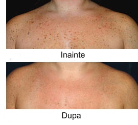 negi si alunite inainte si dupa